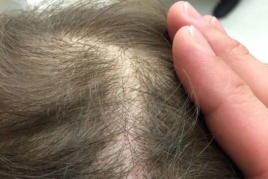 Altijd gedoe met je hoofdhuid? dit zijn de oorzaken en wat wél helpt